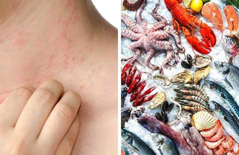Những Loại Hải Sản Dễ Gây Dị Ứng Và Cách Phòng Tránh